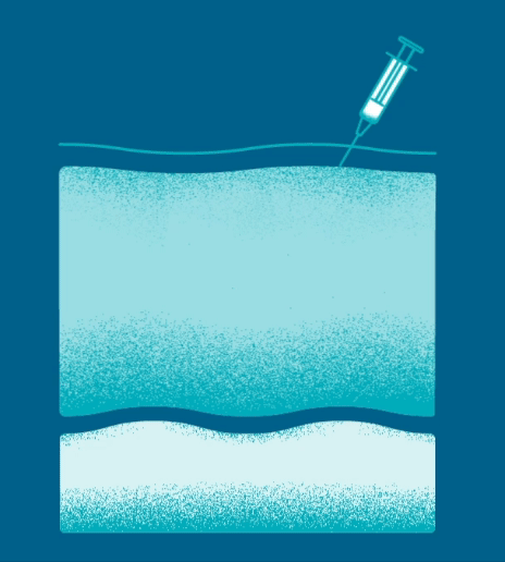 Diagram of the skin layers and the action of injectable hyaluronic acid in the deeper layers.